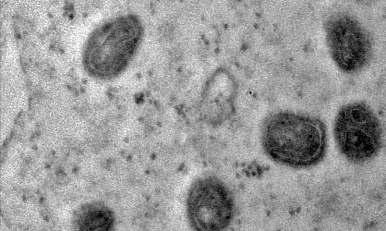 Prudente registra primeiro caso de mpox